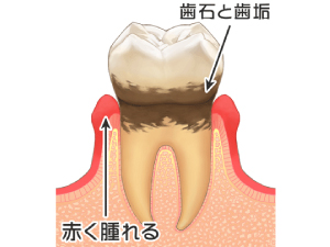 歯周病はどんな流れでどんな治療