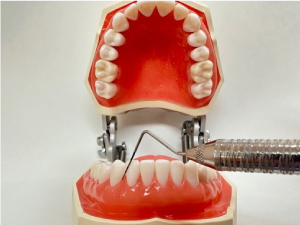 歯周病の検査6点法
