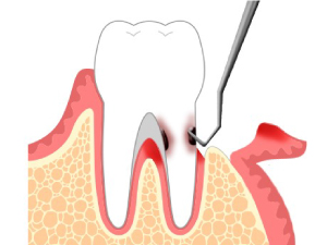 歯周外科療法