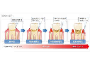 歯周病の症状